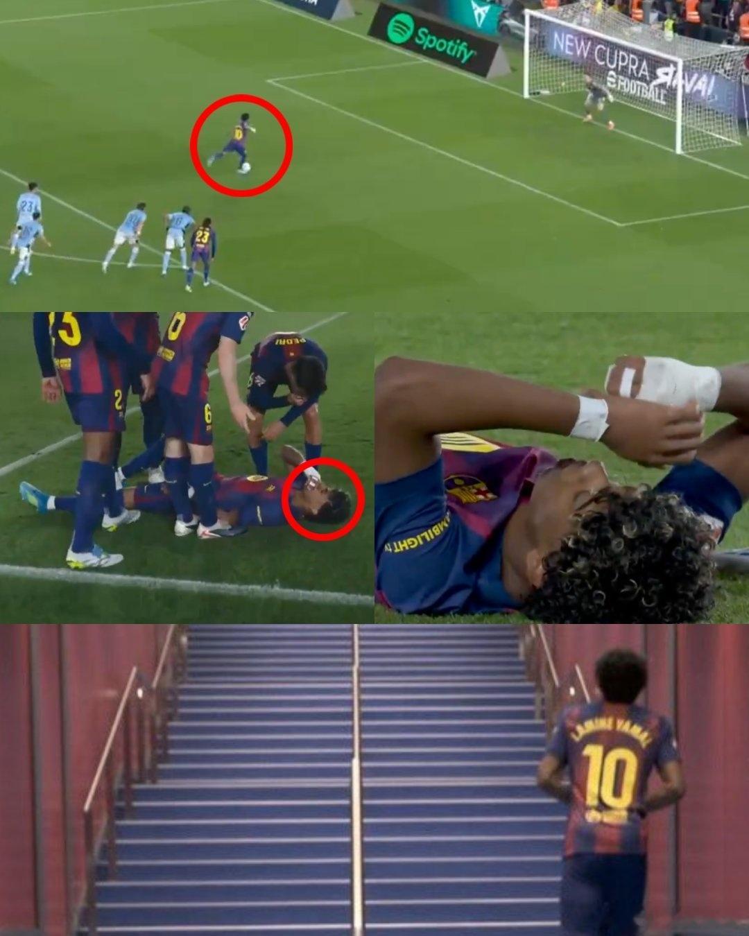 紧急通知：拉明·亚马尔已确定缺席本赛季剩余比赛，可能错过世界杯。他遭遇了腿筋撕裂