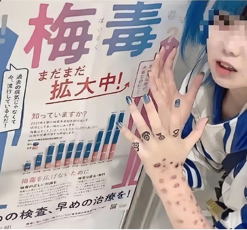 日本年轻人扎堆公开“晒梅毒”，没得病的还专门化妆模仿 