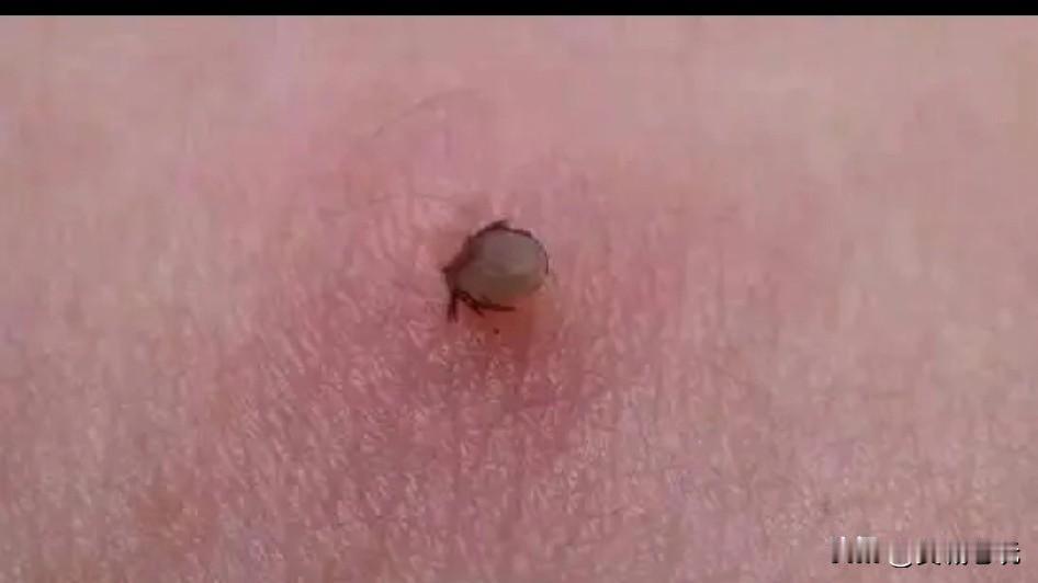 刚才看《今日头条》热榜披露：安徽一位73岁老奶奶身上竟然附着了17只蜱虫，幸亏救