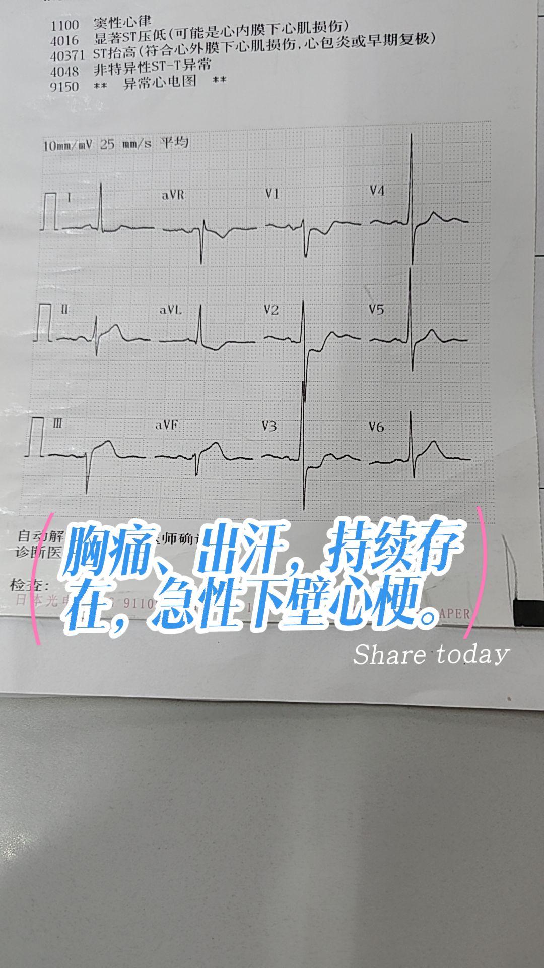 急性心梗。