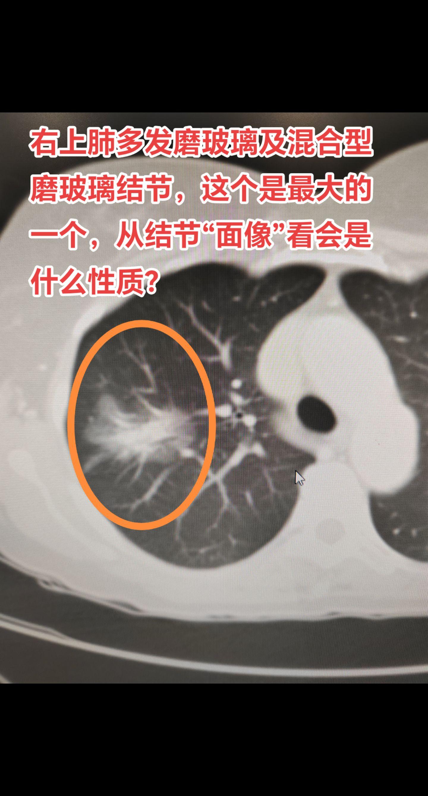 磨玻璃结节及混合型磨玻璃结节。