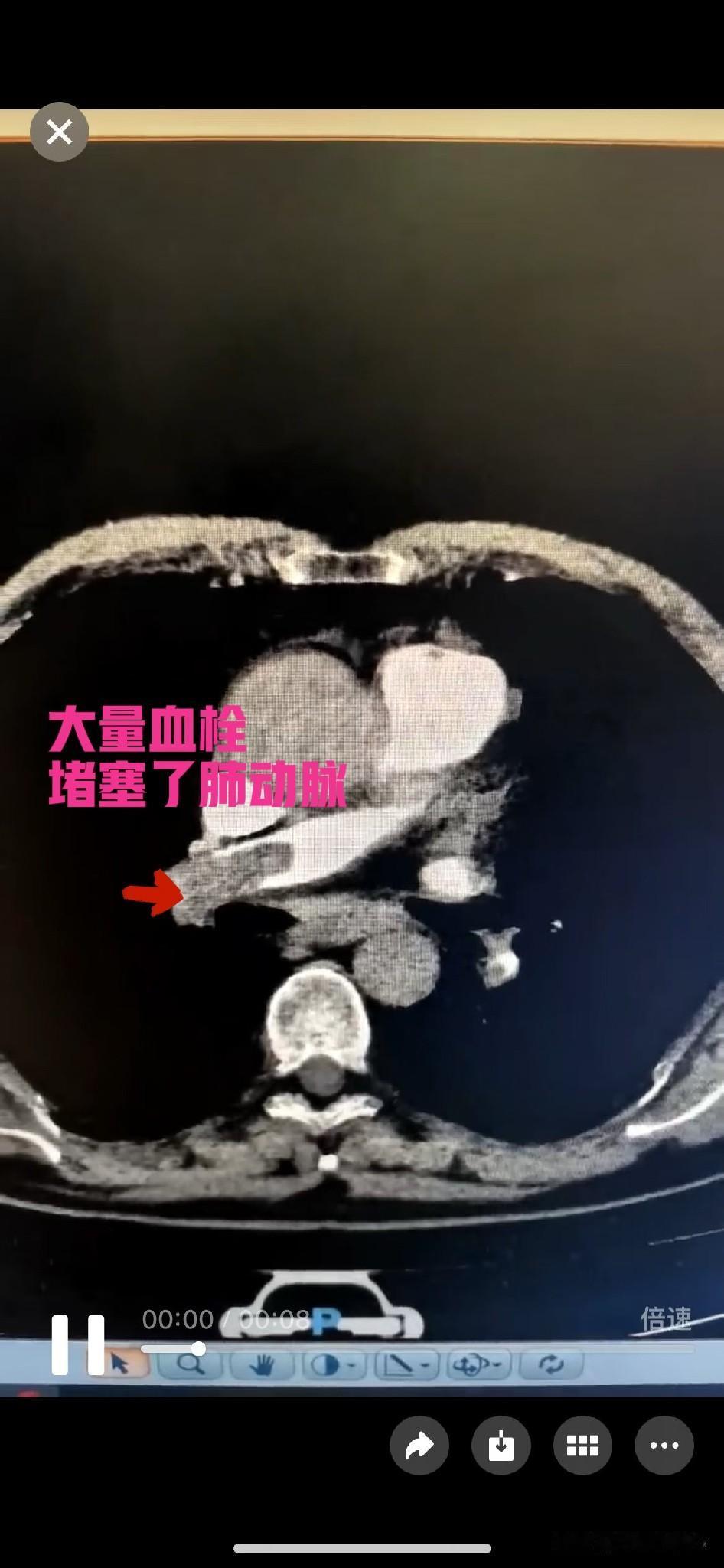 最近碰到一个案例，60岁男性热衷于打麻将。每天牌桌上奋战不少于6个小时。某天心满