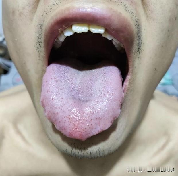 舌头都这样了，还去健脾补脾呢，这种舌头说了八百遍了，先疏通淤堵，活血化瘀！

患