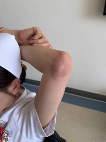 杨超越拍戏手臂大面积淤青 用心揣摩每一个角色，杨超越读懂护士的不易与伟大，拍戏不