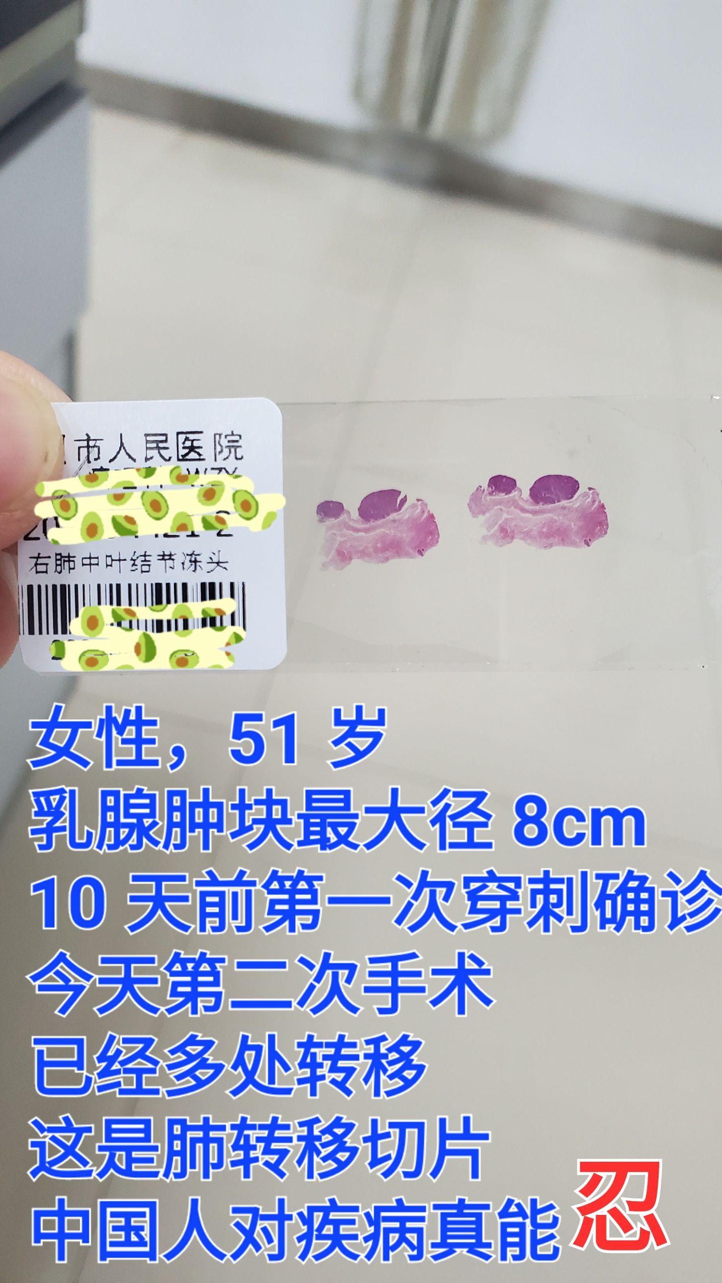 乳腺癌转移