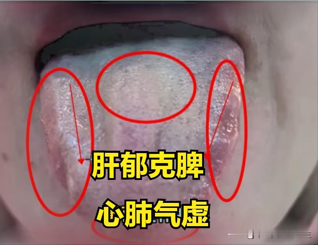 这种舌象要是上来就疏肝，那就是大错特错了，记住疏肝前一定要先打通这两个地方！
