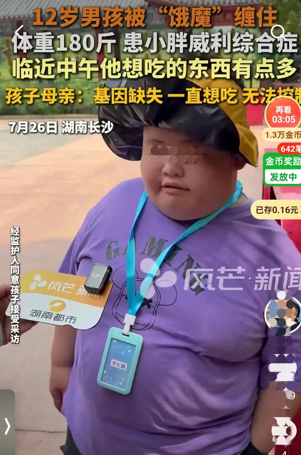 12岁男孩患小胖威利综合征，基因缺失引发的“饿魔”困境
 
最近，湖南长沙一名1
