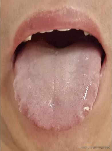 舌面水润，舌边齿痕，看似健是脾虚，但是[狗头][狗头][狗头][狗头]
如果从健