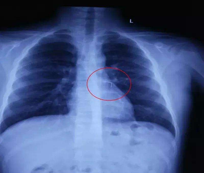 “支气管异物”具体有哪些症状呢? 
支气管异物可不是小事！急性期异物刚呛进去，会