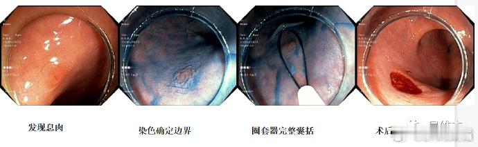 门诊肠息肉切除：肠息肉切除已经是预防肠癌的重要手段，而大多数发现的肠息肉是小于1