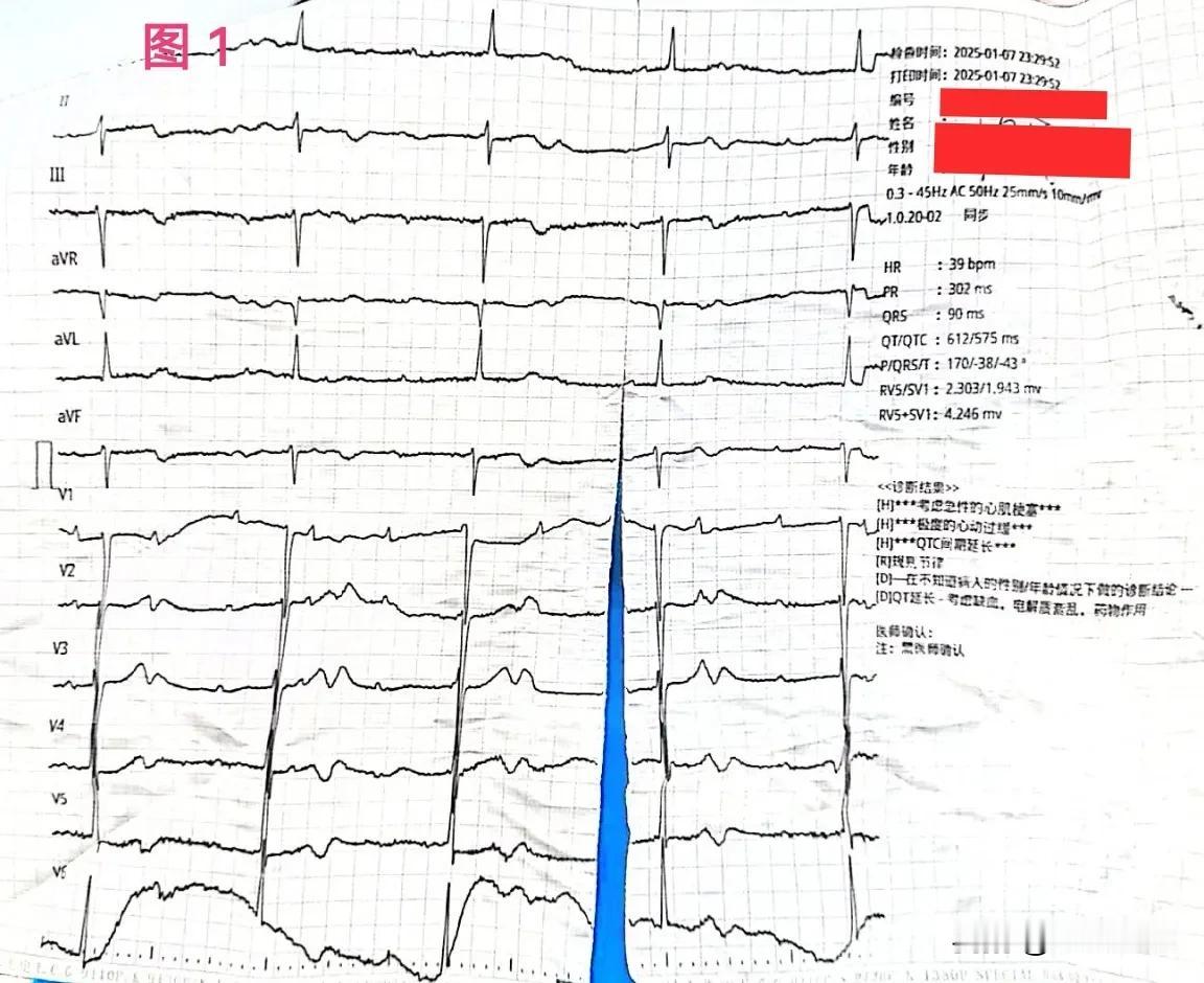 这两幅心电图分别来自于不同患者，图1的质量不是很高，将就着能看。图1心电图示窦性