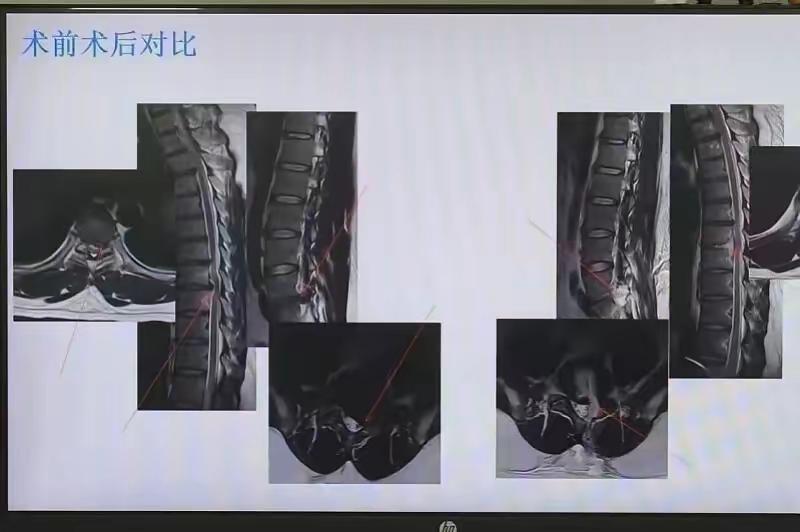 一觉醒来，30岁男子突然瘫痪：一个枕头，差点毁了他一生！

10月1日，广医二院