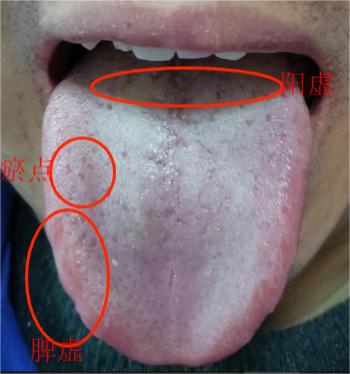 像这种白苔舌，不能盲目祛湿，祛湿之前一定要先升阳！
 
患者主诉：平时总觉得自己