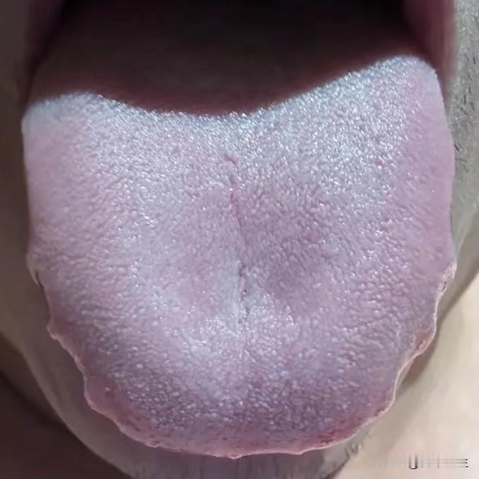 这样的舌头，就算再严重的瘀血，也切忌用血府逐瘀丸、桃红四物丸！根本没用！
 
患