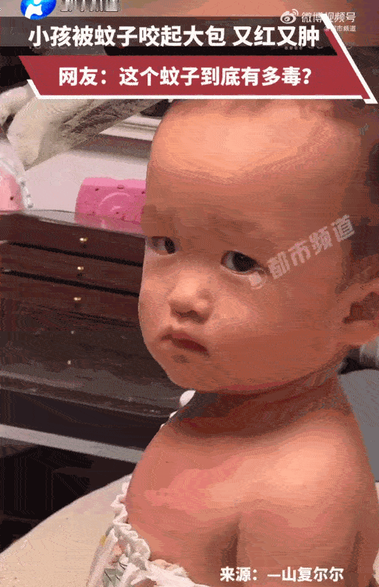 万万没想到！山东，一名小宝宝安稳待在家中，家长突然发现孩子胸前鼓起一块硕大红肿包