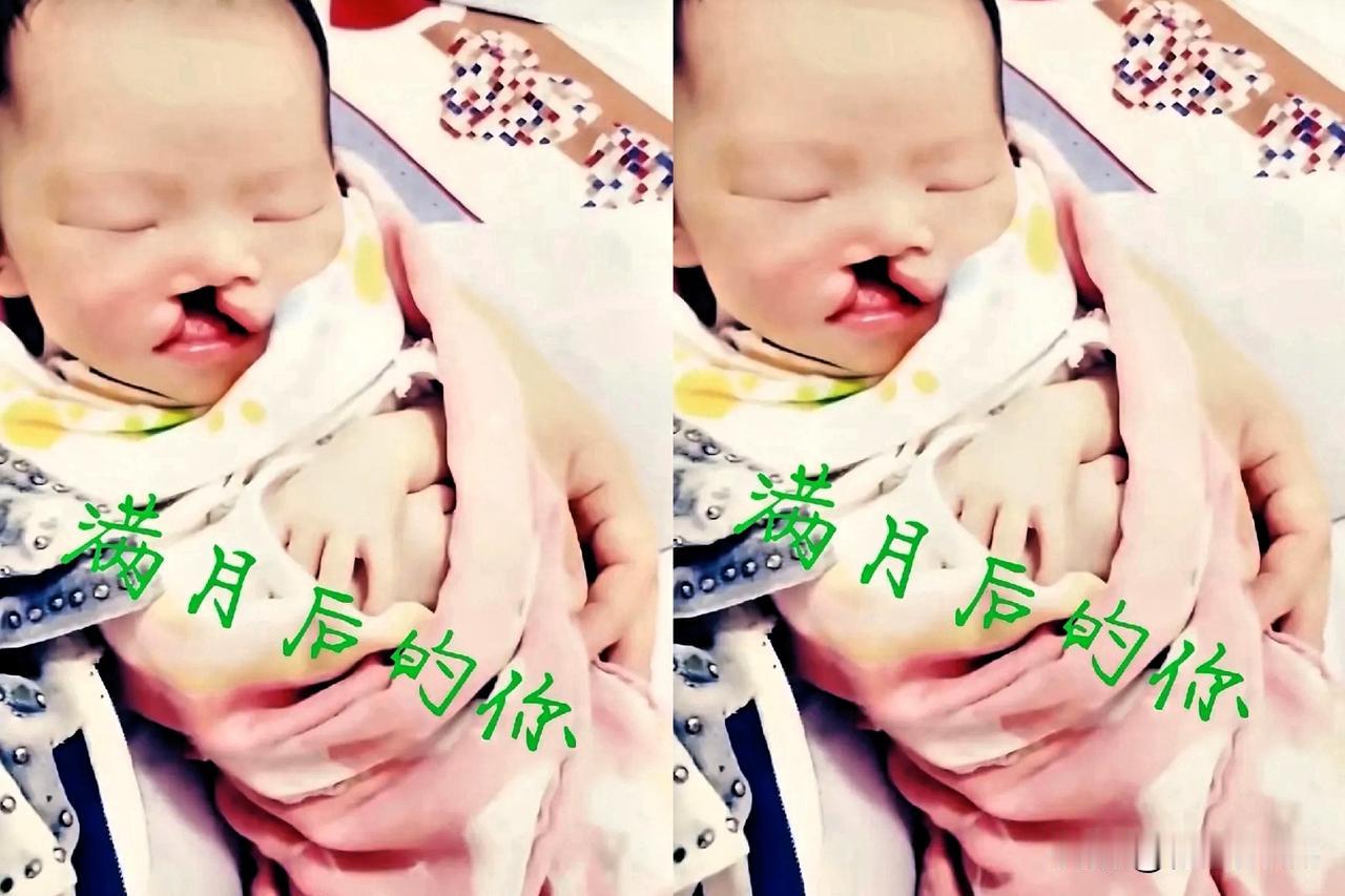 越来越多的唇腭裂受益者勇敢站出来，发声支持鹏哥！

陕西一位母亲在抖音公布女儿于