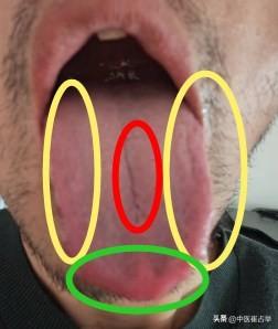 一看这种舌头啊，身体各方面都严重透支了！不仅心肝脾都不好，瘀堵的还厉害！
病人主