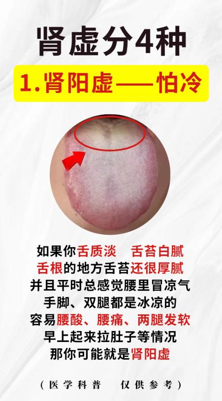 中医舌诊：4 种肾虚的舌象特征与辨证要点