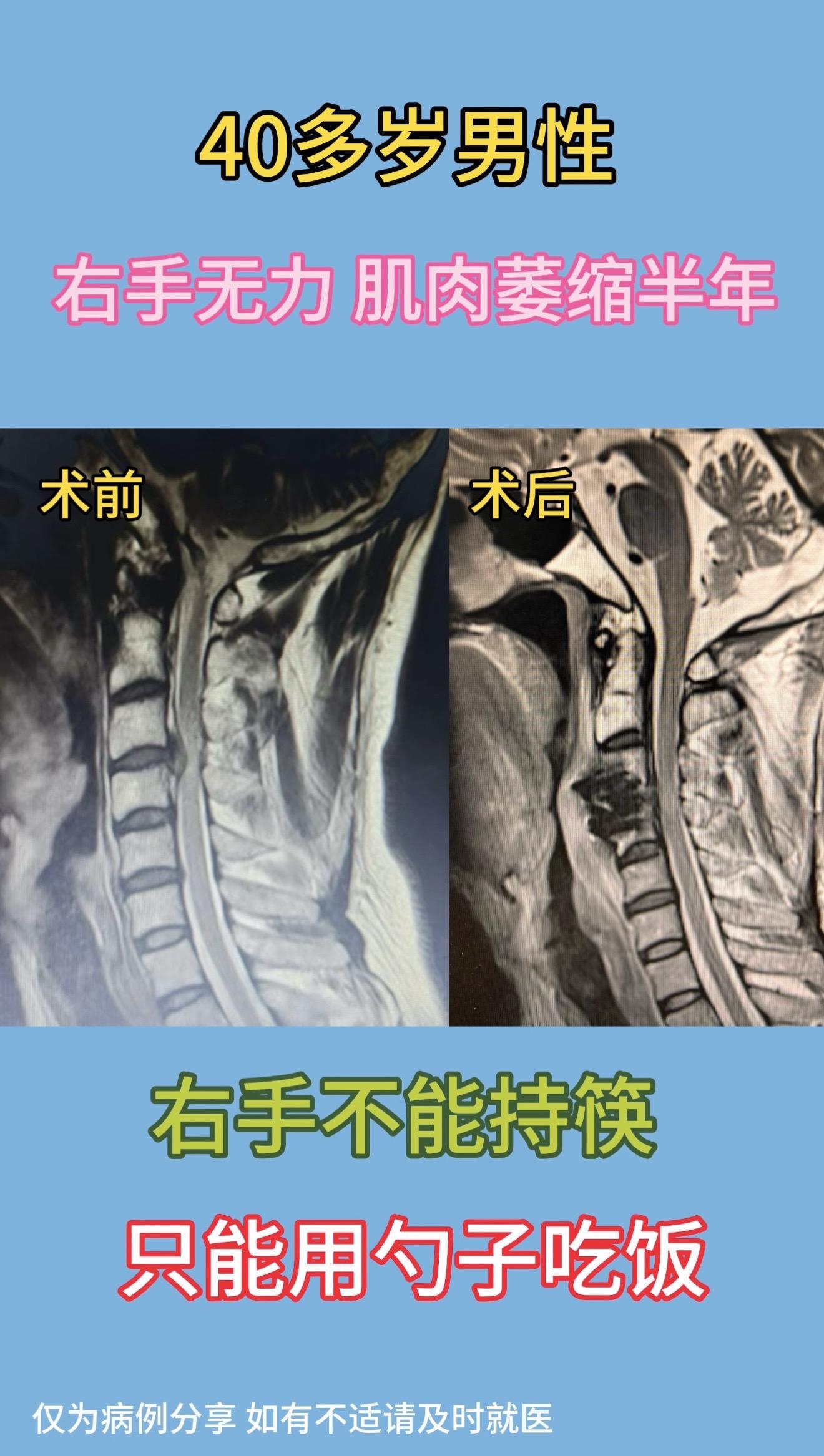 40多岁男性，右手无力、肌肉萎缩半年，右手持筷不能，只能用勺子吃饭。左...