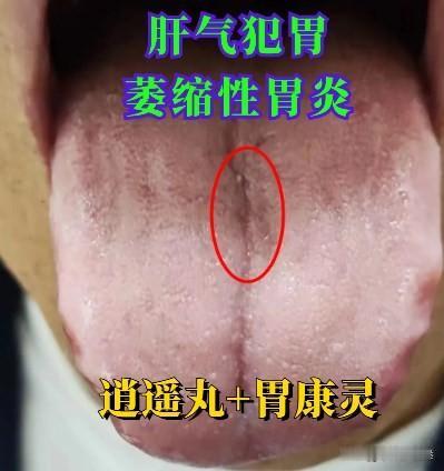 逍遥丸的神奇搭配：不仅能通全身上下气血，还能轻松调理5种情况
一：逍遥丸+胃康灵