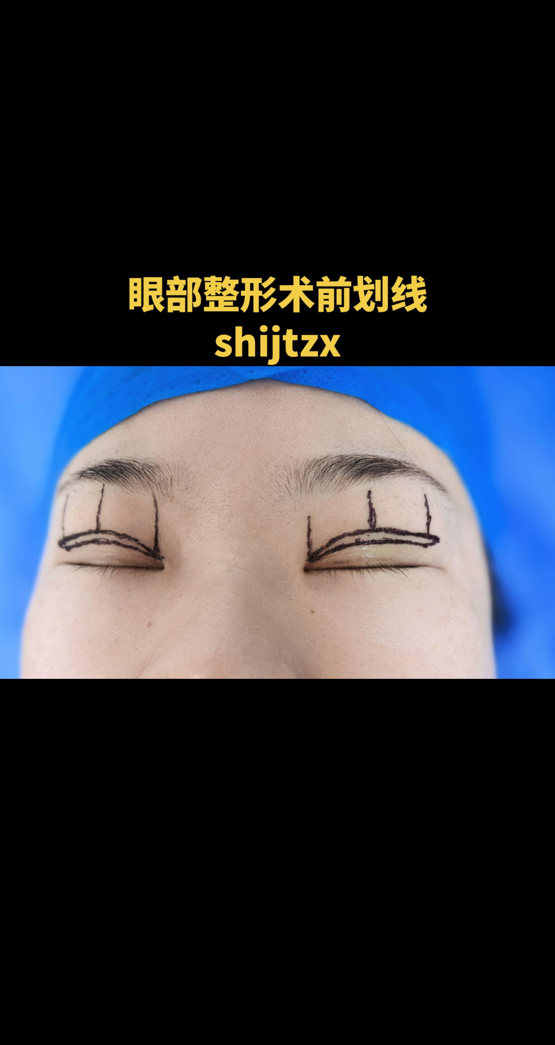 术前设计划线。眼部整形术前划线