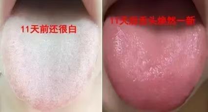 11天！顽固白腻苔彻底消失，中医：只靠这关键一步！

这位患者初来时：整个舌头被