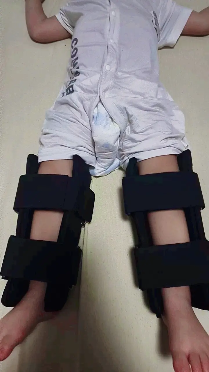 足内翻矫正记录 扁平足矫正 o型腿矫正罗圈腿矫正