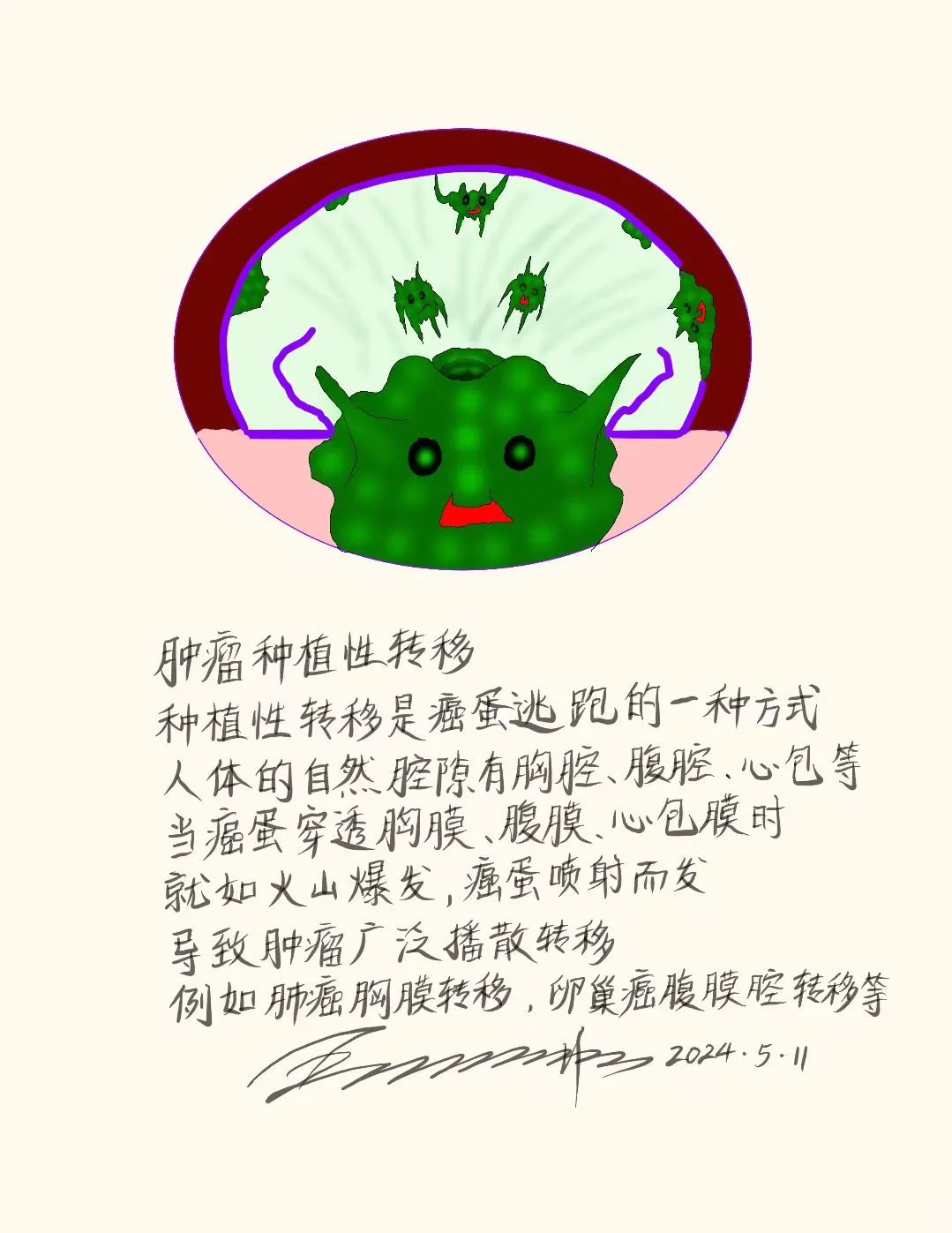 肿瘤种植性转移