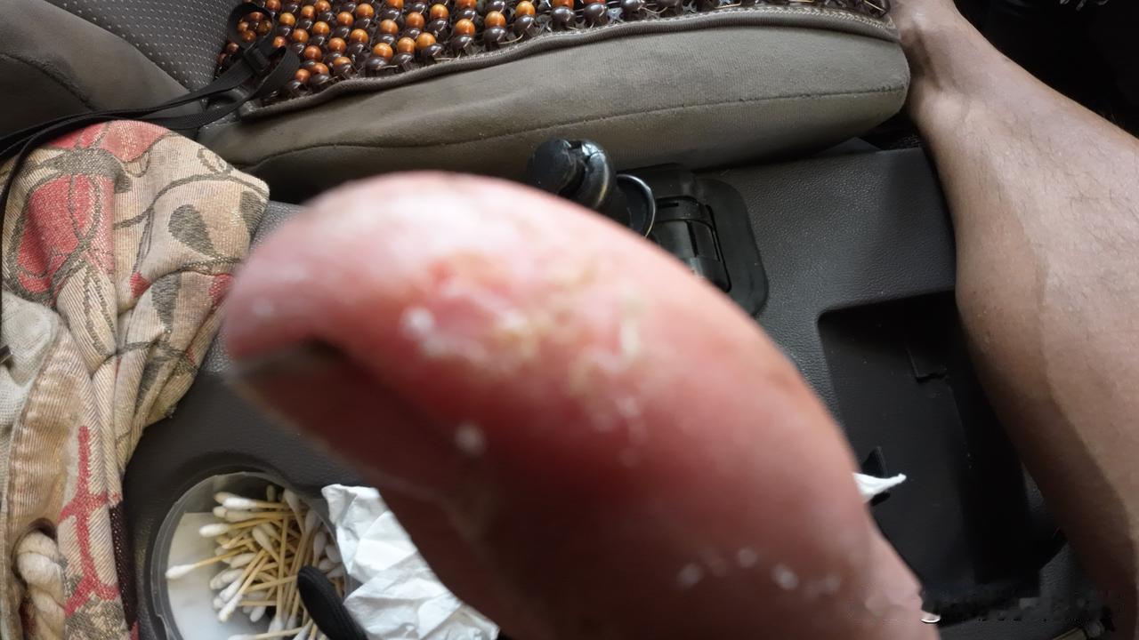 作者加速成长计划前几天不小心被蚂蚁蜇了一下，之后患处就一直发痒，没料到昨天痒得格
