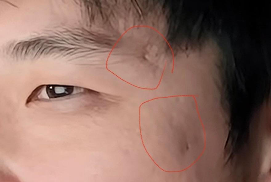 男性强势面相一则：三角眼+太阳穴位置坑坑洼洼（坑、疤、痘印）=看待大多数事物比较