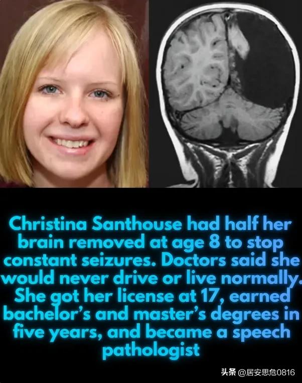 医生曾预言克里斯蒂娜·桑特豪斯永远无法过上正常的生活。然而，在失去半个大脑后，她