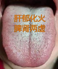 宗筋不起，好不容易来一次，几秒就泻了，自己也是很无奈！
 
患者情况：宗筋不起，