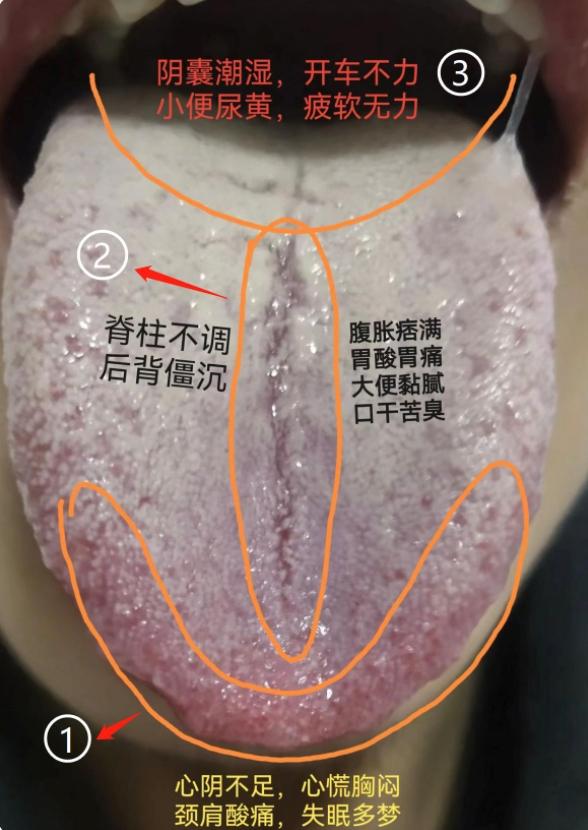 门诊上的男性患者，舌苔又厚又腻的，裂纹还特别深，男科指定不太好了
标记1：舌头尖