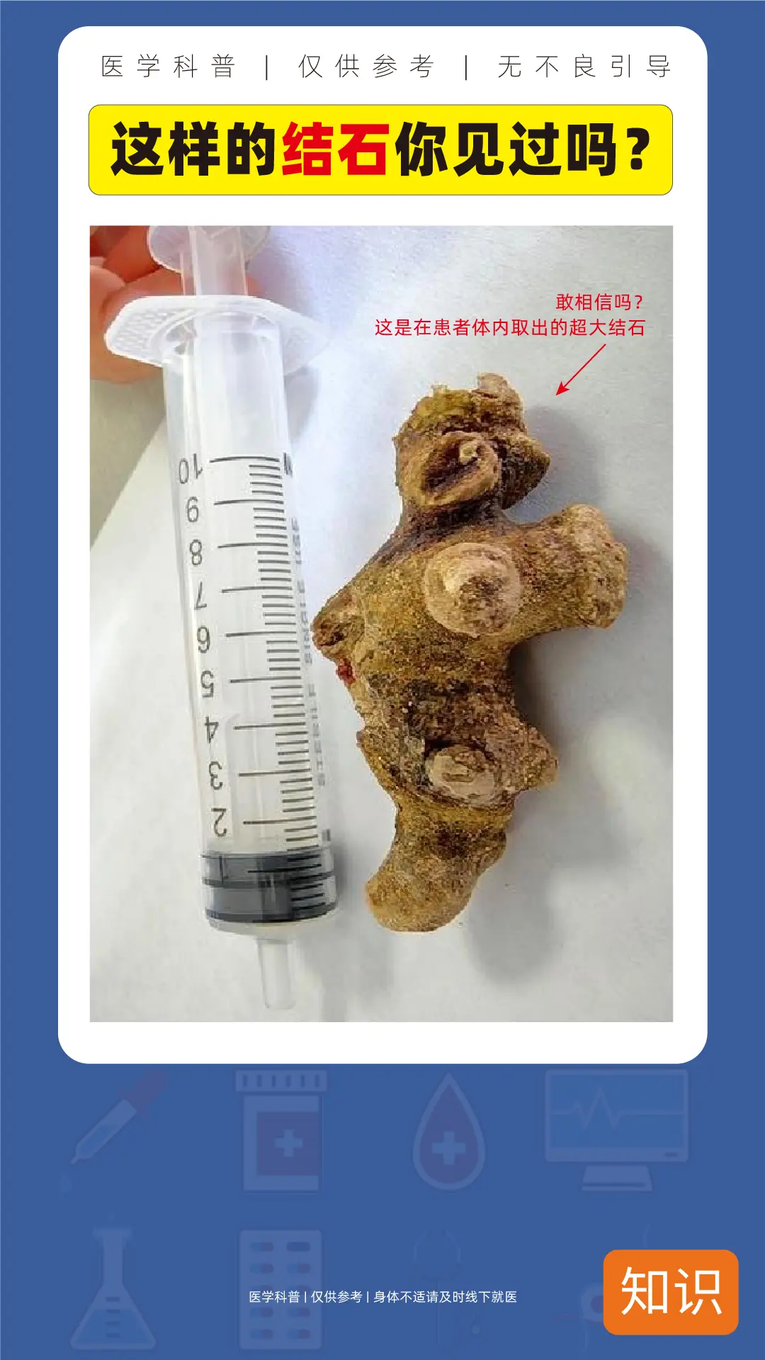 这样的结石你见过吗？