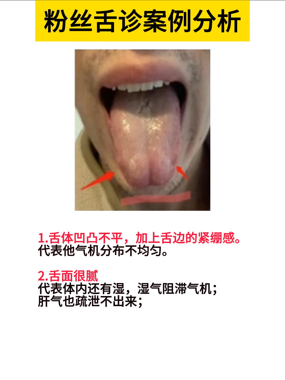 今日粉丝舌诊案例分析，对照看看，你能从自己的舌头上看出来什么问题呢？[谢谢][谢