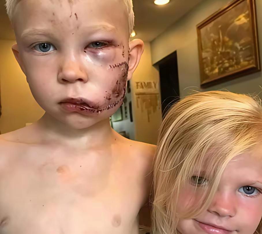 这个小男孩从一只牧羊犬口中救出了他的小妹妹，他全身缝了90针，但把他三岁的妹妹从