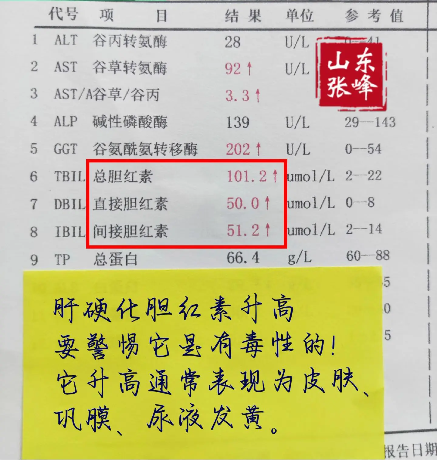胆红素是反映肝脏代谢能力的重要指标，肝脏代谢能力降低大量的胆红素淤积进...