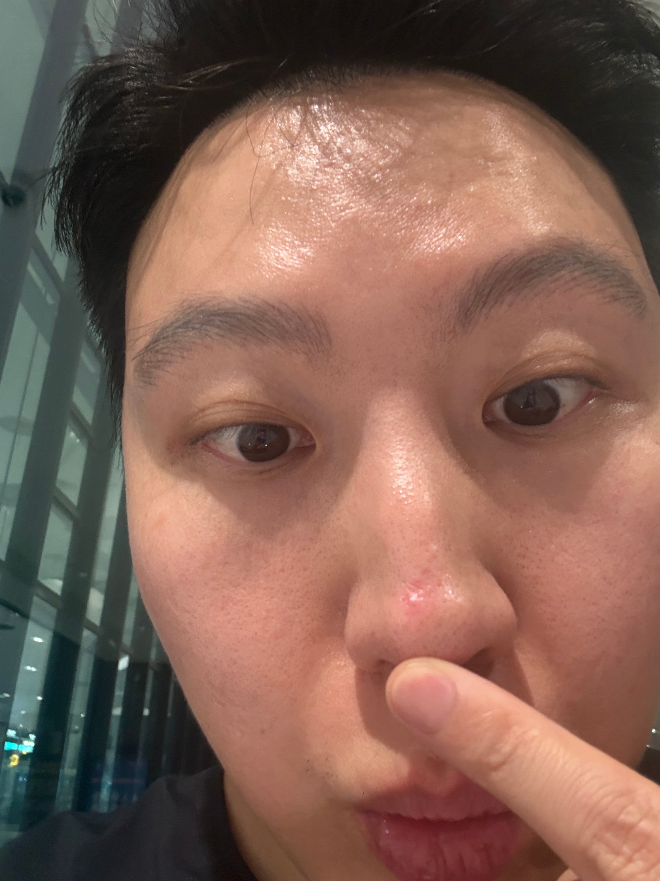 昨天去北京的时候还没有，今天冒出来的，看到没，人不能被气！！气了就长痘 