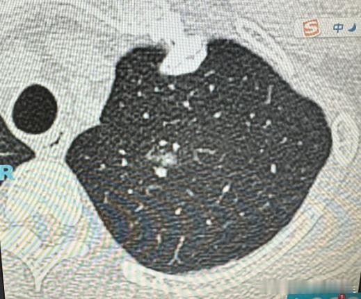 肺结节是怎么做到3个月消失的？是不是吃了什么“神药”？小伙体检发现1cm肺磨玻璃