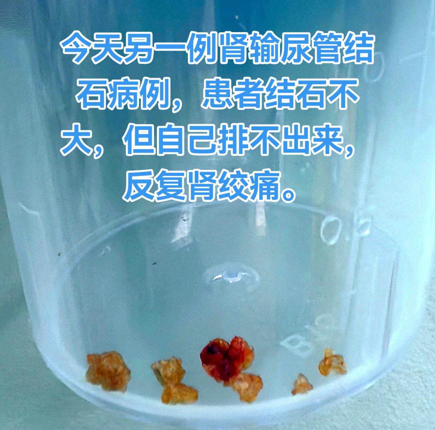 输尿管镜钬激光碎石取石术。