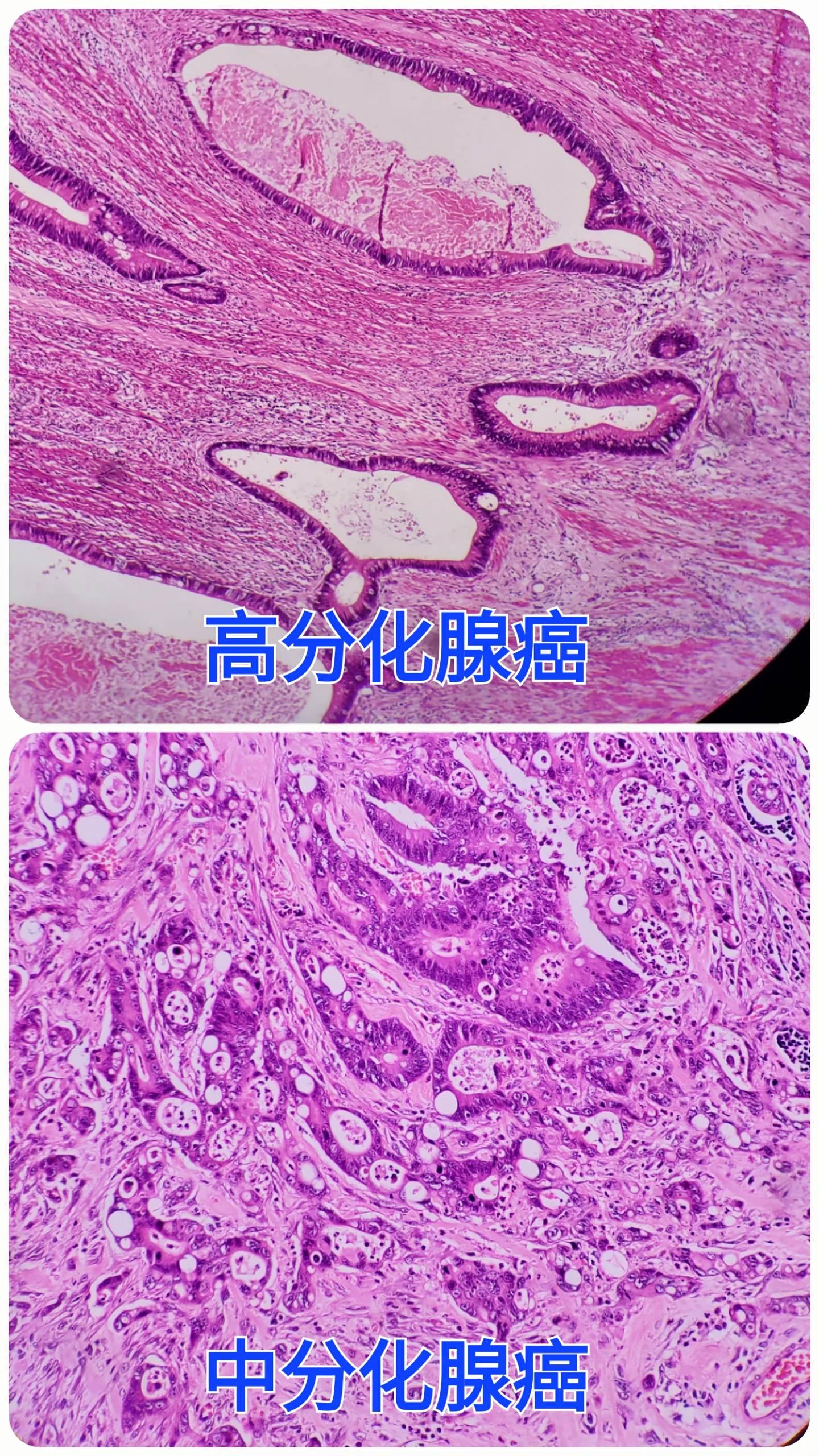 直肠癌