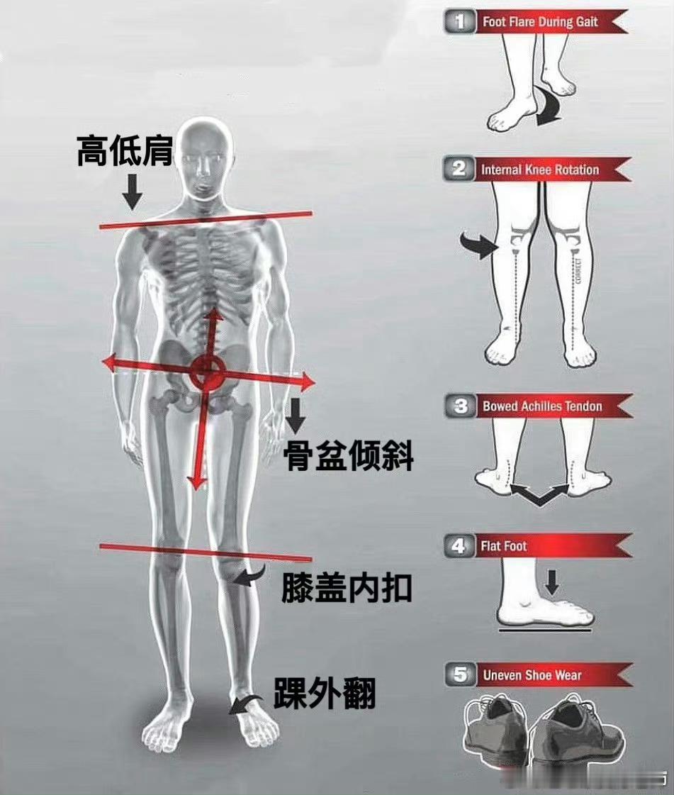 #运动康复# 来对照一下，你的身体有没有“歪”，你的膝盖疼痛，腰突腰痛，可能都有