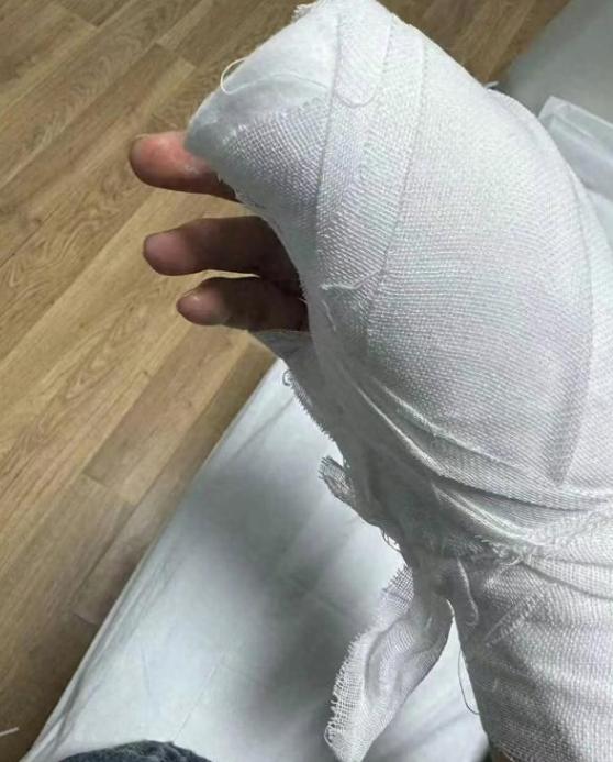 3 元美工刀毁了入职路！见习医生拆快递被割伤手神经。

内蒙古一名即将入职医院的