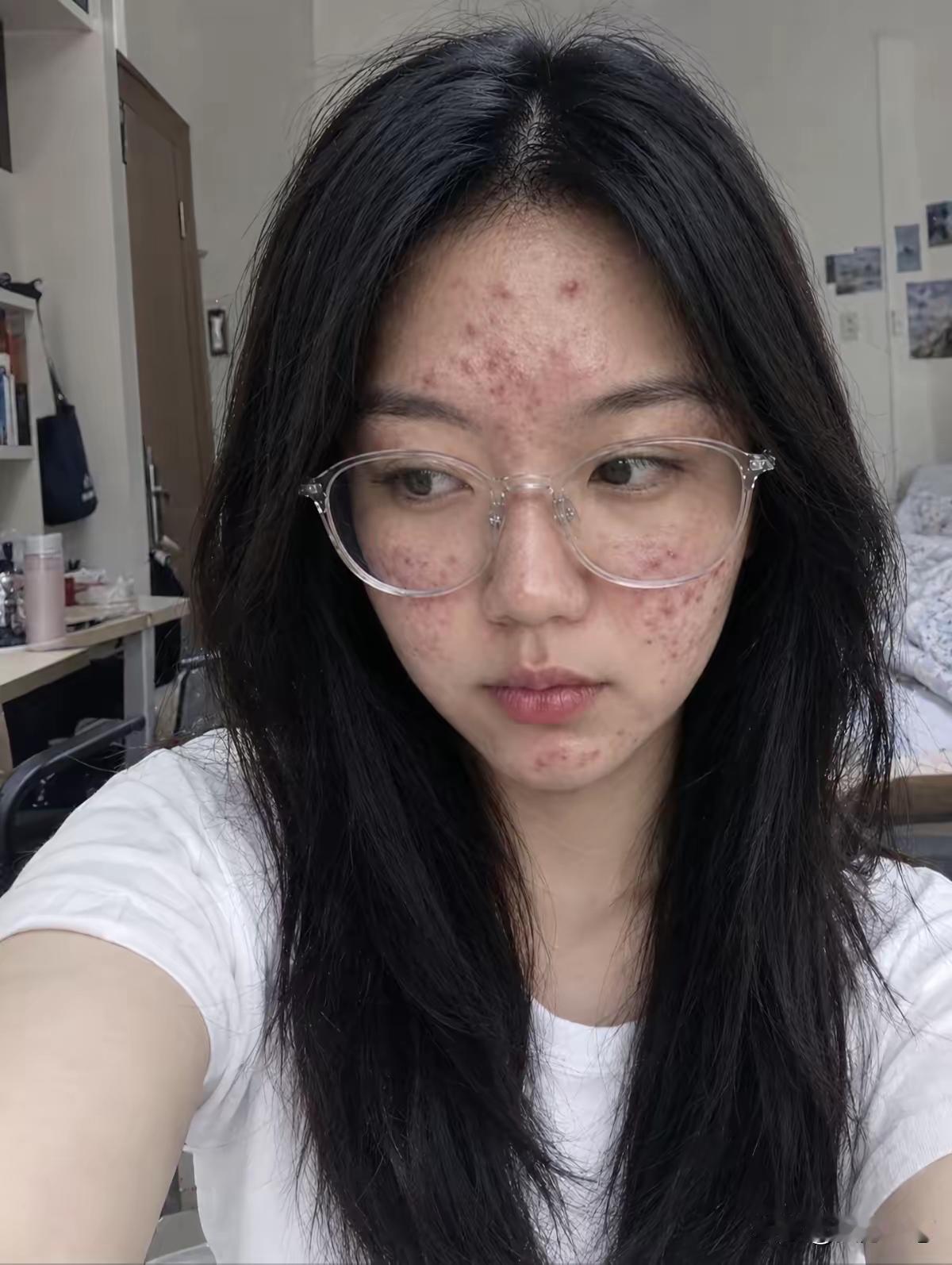 这不是青春痘吧，消灭它需要什么
