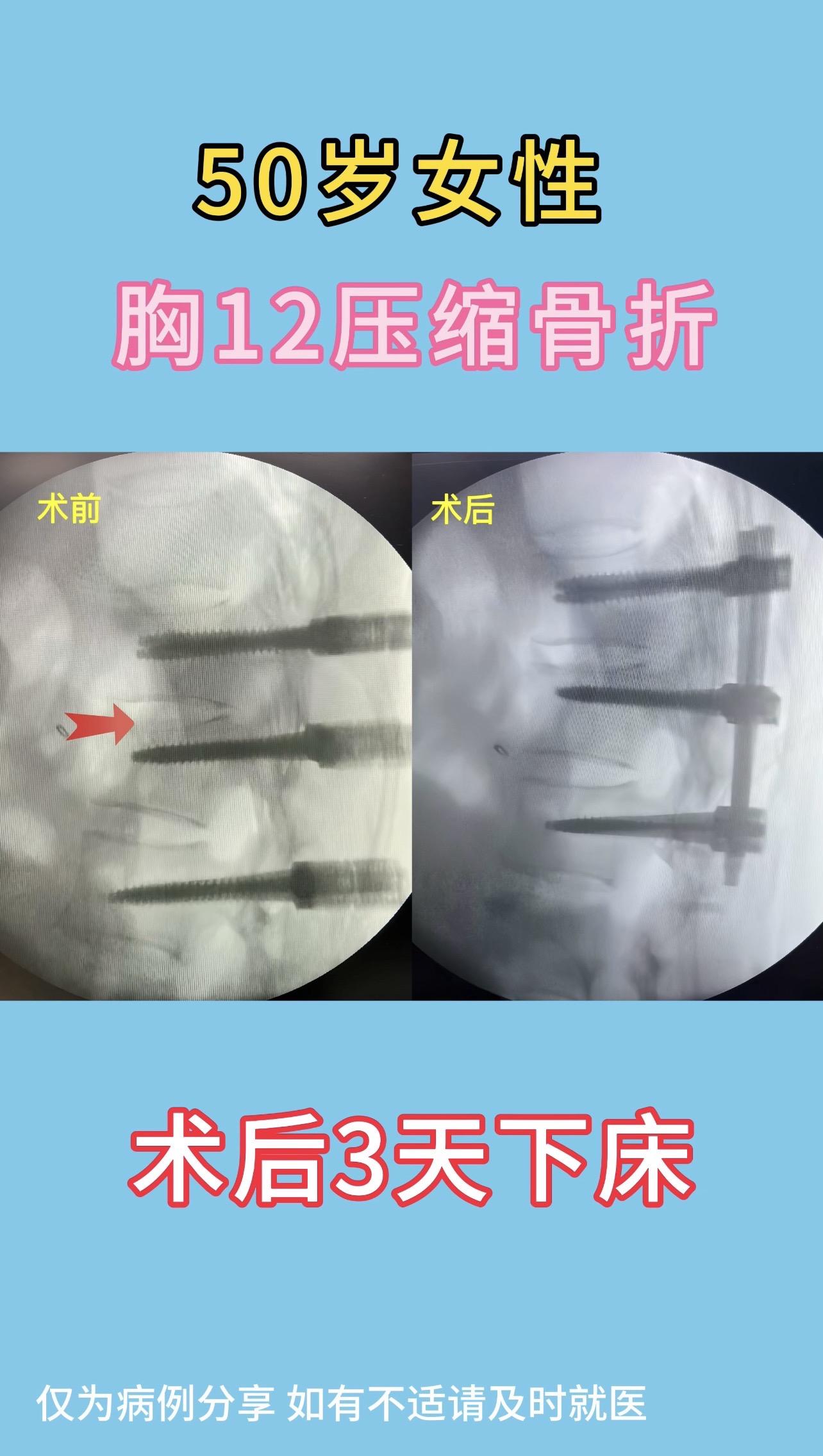 50岁女性，胸12压缩骨折。伤后4天手术，椎体高度完全恢复，病人术后3...