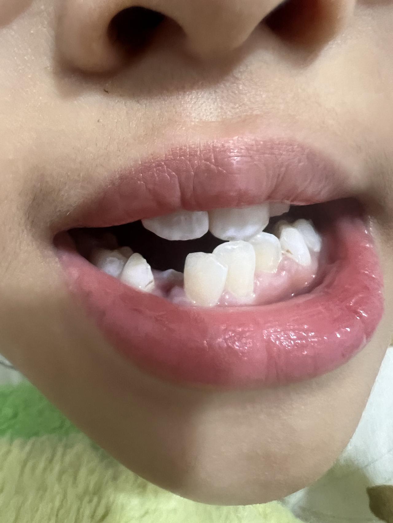 带女儿拔滞留的乳牙，没想到遇到了一个良心牙医。趁着今天是周日，带女儿去牙科诊所去