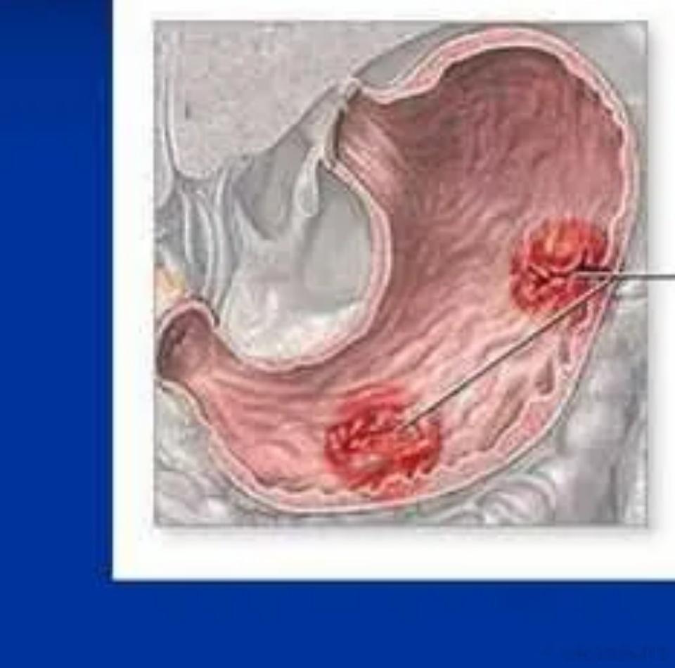 胃癌早期不痛不痒？提醒：身体出现3个症状，可能暗示癌症来临1、消化不良胃癌早期最