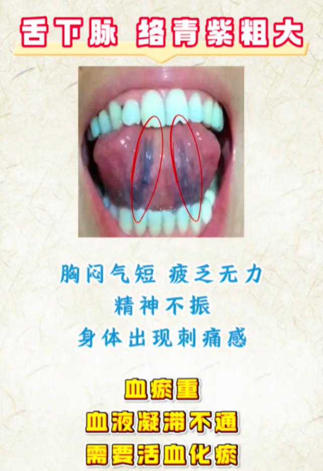 齿痕舌、黄腻苔、草莓舌分别代表什么？看看你属于哪一种