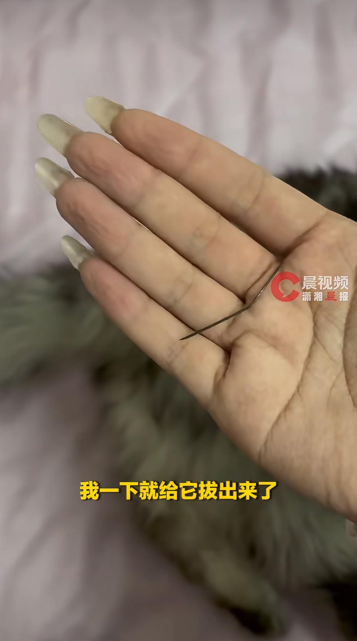 难以相信！女子左臀疼了一个月，开始只当是运动拉伤没放心上，后来疼得半边身子都像指