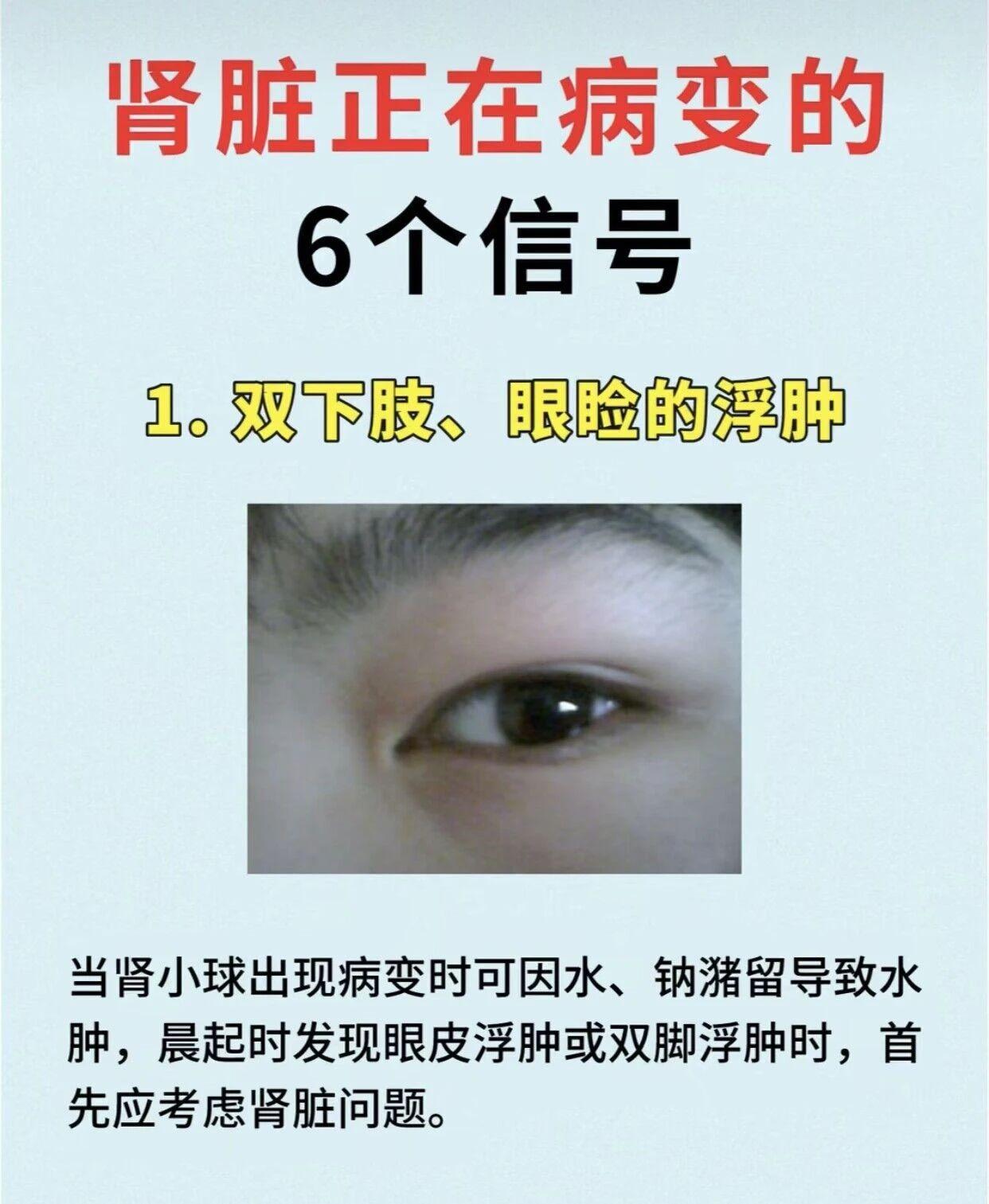 肾脏正在病变的6个信号